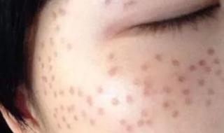 激光治疗雀斑的价格